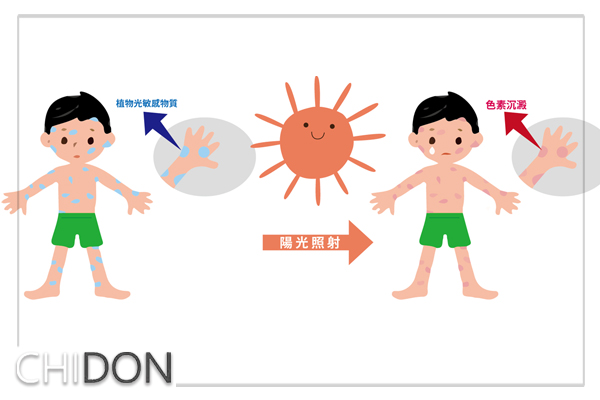 淺談植物性感光性皮膚炎